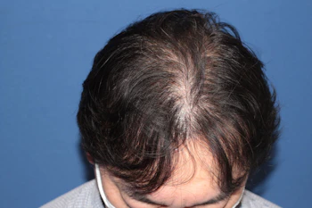 50代 男性 H.M.さん 生え際・前頭部・頭頂部 自毛植毛（MIRAI法）2,000株の症例｜自毛植毛の症例（手術1年後）