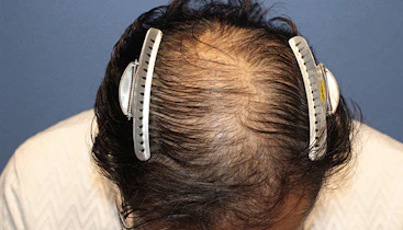 50代 男性  H.O.さん 生え際・前頭部（MIRAI法）2,000株の症例｜自毛植毛の症例（手術前）