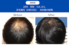 20代 男性 N.K.さん／頭頂部の自毛植毛(MIRAI法)／800株の症例