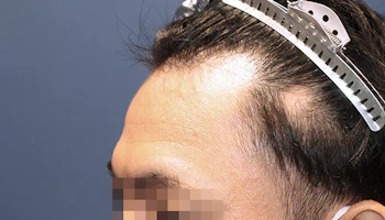 30代 男性 M.W.さん 生え際・瘢痕部 自毛植毛（MIRAI法）1,200株の症例｜自毛植毛の症例（手術前）