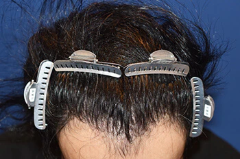 30代 男性 S.T.さん 前頭部～頭頂部 自毛植毛（MIRAI法）1,500株の症例（術後1年の経過）