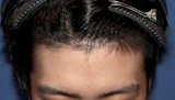 20代 男性 Y.N.さん 生え際 自毛植毛（MIRAI法）1,000株の症例｜自毛植毛の症例（手術前）