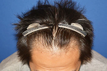 30代 男性 A.Y.さん 生え際 自毛植毛（MIRAI法）1,000株の症例（手術前の状態）