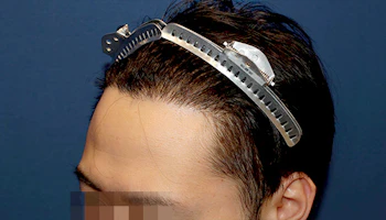 30代 男性 H.H.さん 生え際 自毛植毛（MIRAI法）1,500株の症例｜自毛植毛の症例（手術後：左側）