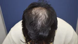 30代 男性 M.Y.さん 頭頂部・つむじ 自毛植毛（MIRAI法）1,800株の症例｜自毛植毛の症例（手術前）