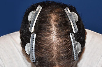 40代 男性 N.Y.さん 前頭部・頭頂部 自毛植毛（MIRAI法）2,000株の症例（術後1年の経過）