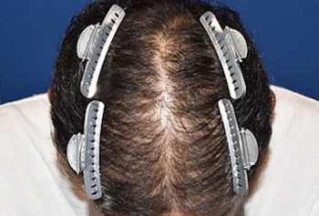 40代 男性 N.Y.さん 前頭部・頭頂部 自毛植毛（MIRAI法）2,000株の症例（手術後1年経過状態）