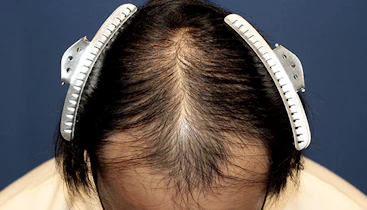 20代 男性 D.H.さん 生え際・頭頂部 自毛植毛（MIRAI法）2,000株の症例｜自毛植毛の症例（手術前）