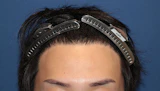20代 男性 T.E.さん 生え際 自毛植毛（MIRAI法）1,000株の症例｜自毛植毛の症例（手術後）