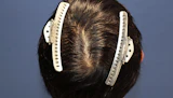 40代 男性  K.A.さん 頭頂部・つむじ 自毛植毛（MIRAI法）600株の症例｜自毛植毛の症例（手術前）