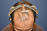 50代 男性 O.N.さん 前頭部 自毛植毛（MIRAI法）2,000株の症例｜自毛植毛の症例（手術前）