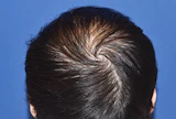 30代 男性 W.Y.さん 前頭部・頭頂部 自毛植毛（MIRAI法）2,700株の症例｜自毛植毛の症例（手術前）