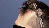 30代 男性 S.K.さん 生え際 前頭部 自毛植毛（MIRAI法）1,700株の症例｜自毛植毛の症例（手術前）