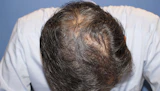 50代 男性  H.O.さん 生え際・前頭部（MIRAI法）2,000株の症例｜自毛植毛の症例（手術後）