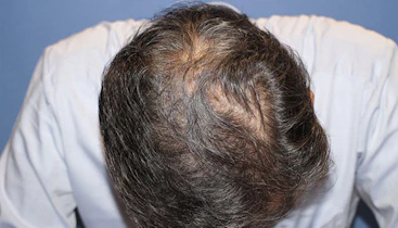50代 男性  H.O.さん 生え際・前頭部（MIRAI法）2,000株の症例｜自毛植毛の症例（手術後）