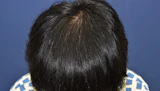 40代 男性 R.T.さん 生え際 自毛植毛（MIRAI法）1,000株の症例｜自毛植毛の症例（手術後）