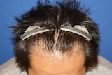 30代 男性 A.Y.さん 生え際 自毛植毛（MIRAI法）1,000株の症例｜自毛植毛の症例（手術前）