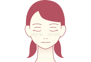 そばかす（雀卵斑）