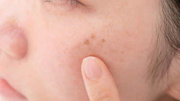 【シミのレーザー治療とは？】仕組みや種類、注意点、アフターケアを美容皮膚科医が解説