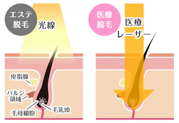 医療レーザー光の到達範囲イメージ
