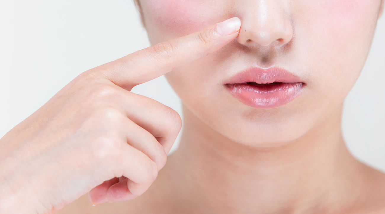 【鼻ニキビとは？】原因と予防法、キレイに治すコツを解説