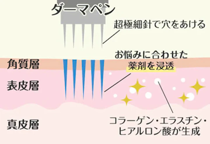 ニキビ跡や小じわ、毛穴の開きの改善に！ケミカルピーリング×ダーマペン