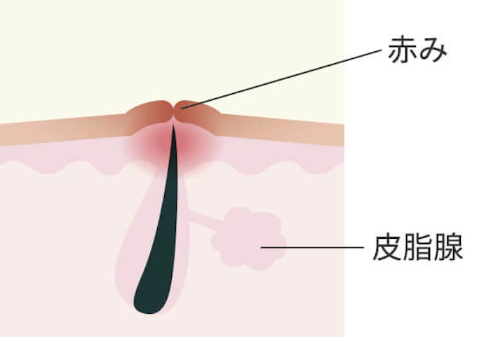 赤みタイプのニキビ跡