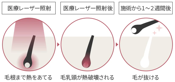 医療脱毛とは？