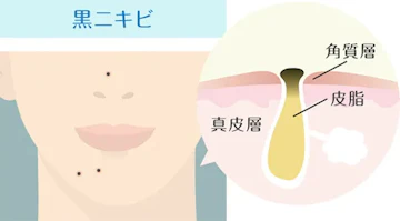 黒ニキビ
