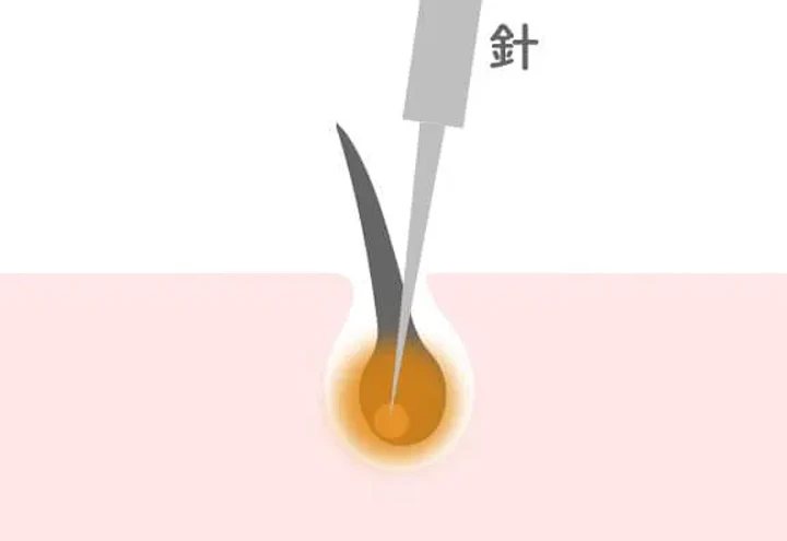 ニードル脱毛