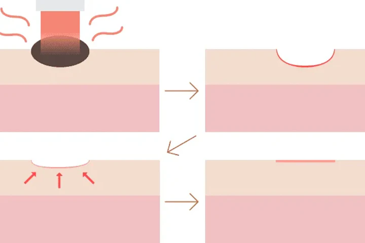 傷跡になりにくい「CO2レーザー」