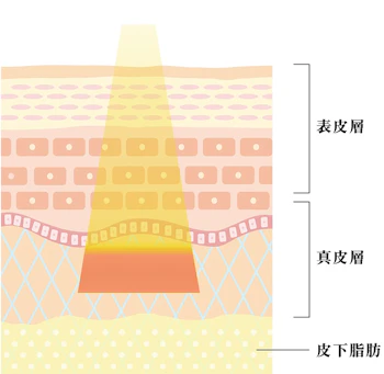 フラクショナルRF治療