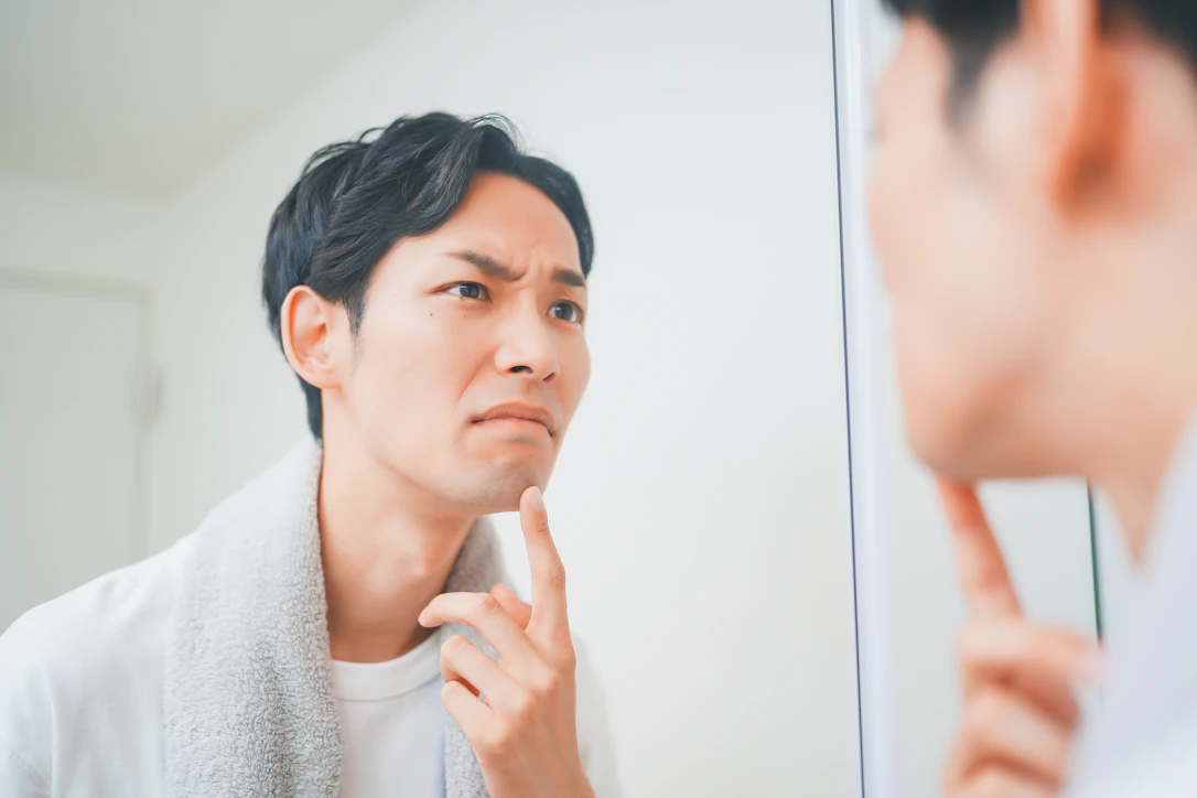 【男性ニキビ】原因と正しいスキンケア、再発を防ぐ最新の美肌治療も解説