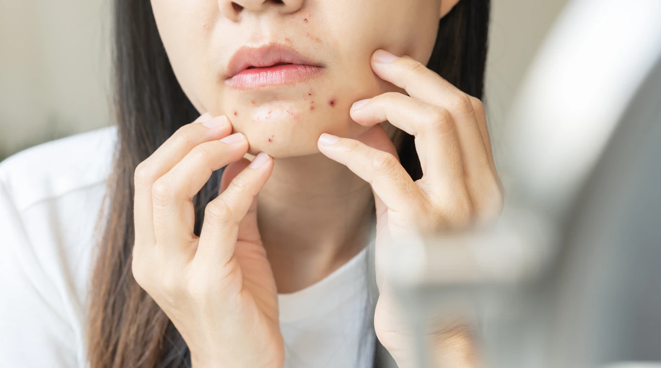 【顎（あご）ニキビ】繰り返す原因と対策、しつこい再発を止める美容皮膚科の治療法