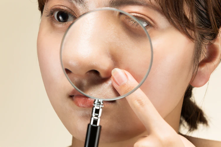 気になるいちご鼻の治し方と予防方法【美容皮膚科医監修】