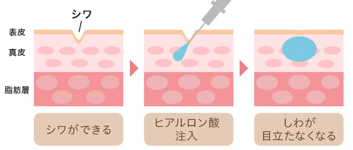 固定されたしわ改善にはヒアルロン酸がおすすめ