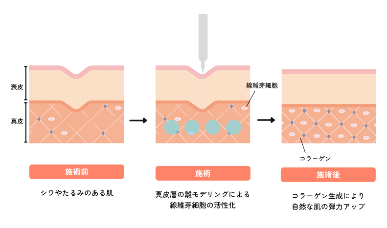 美容医療で取り入れるヒアルロン酸