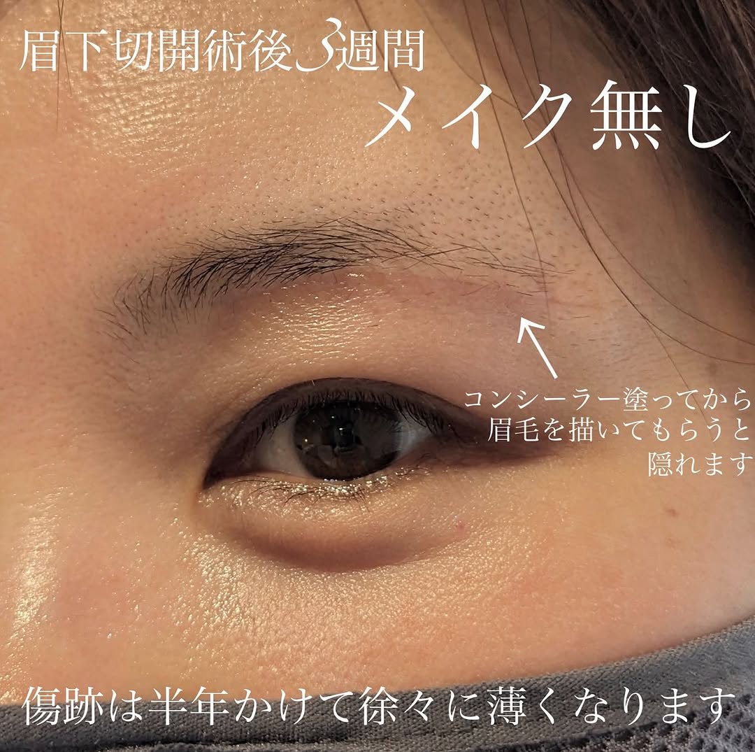 眉下切開でまぶたのたるみを改善し少し昔の自分に戻った症例（術後1ヶ月） 画像2