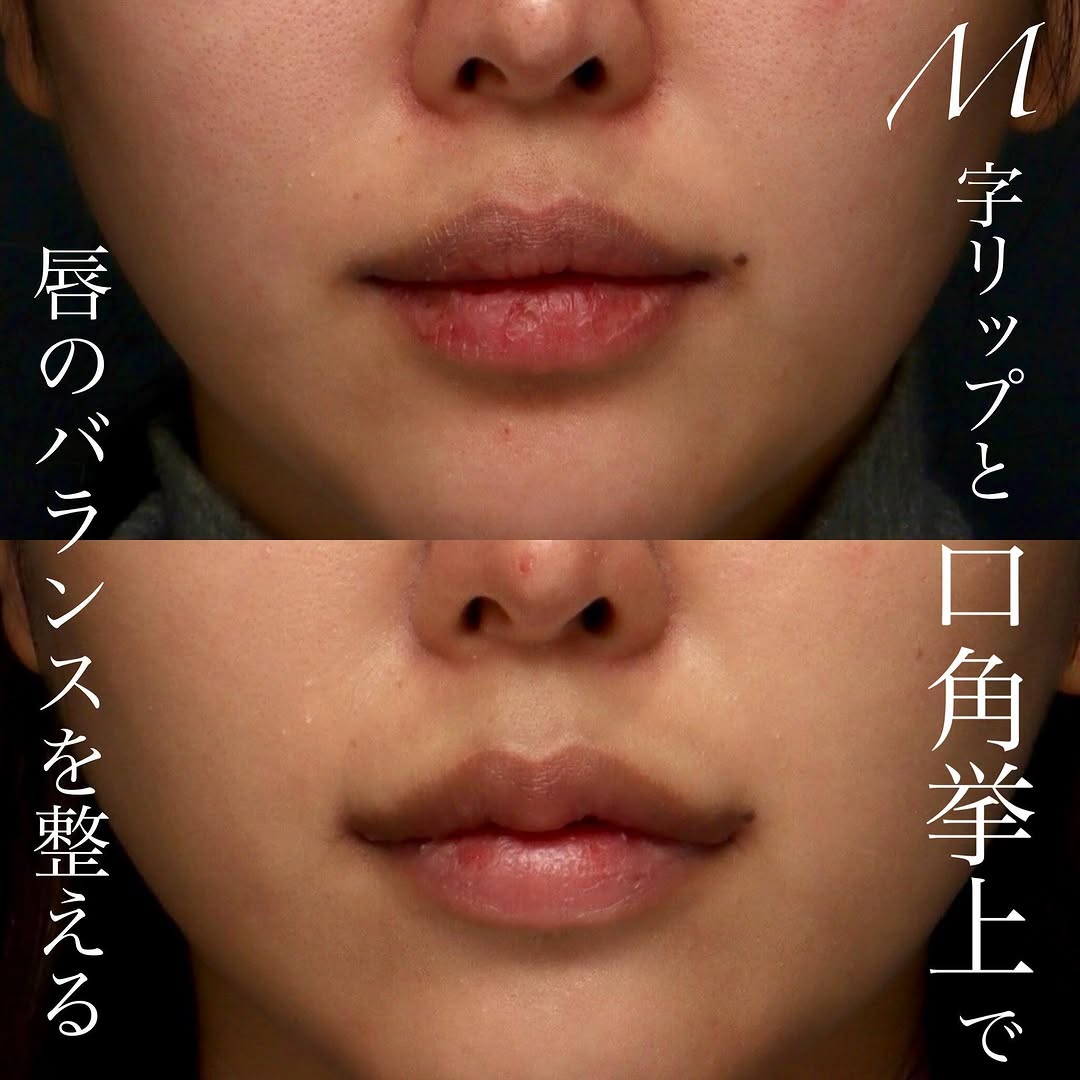 M字リップ＋口角挙上の複合手術でかわいくメリハリのある口元に整えた症例