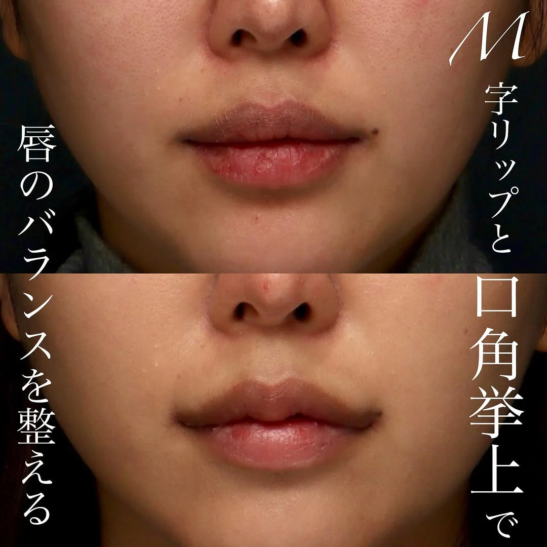 M字リップ+口角挙上の複合手術でかわいくメリハリのある口元に整えた症例