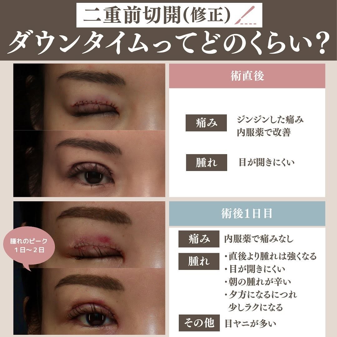 二重全切開（修正）のダウンタイムはどのくらい？術直後〜1ヶ月の経過と過ごし方を解説 画像3