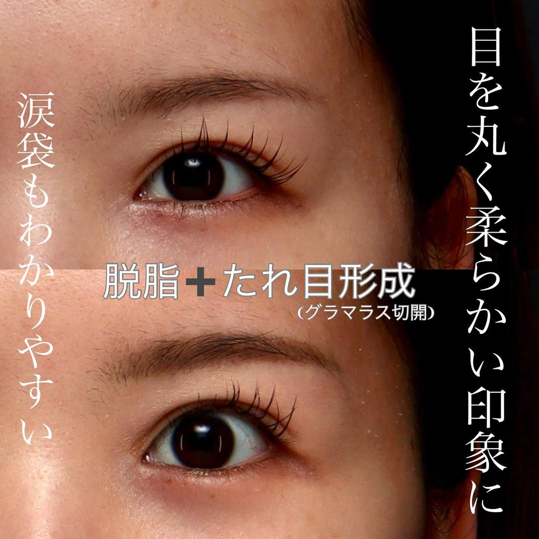 脱脂（くまとり）＋グラマラス（たれ目形成）で中顔面が短く見える丸い目元に整えた症例