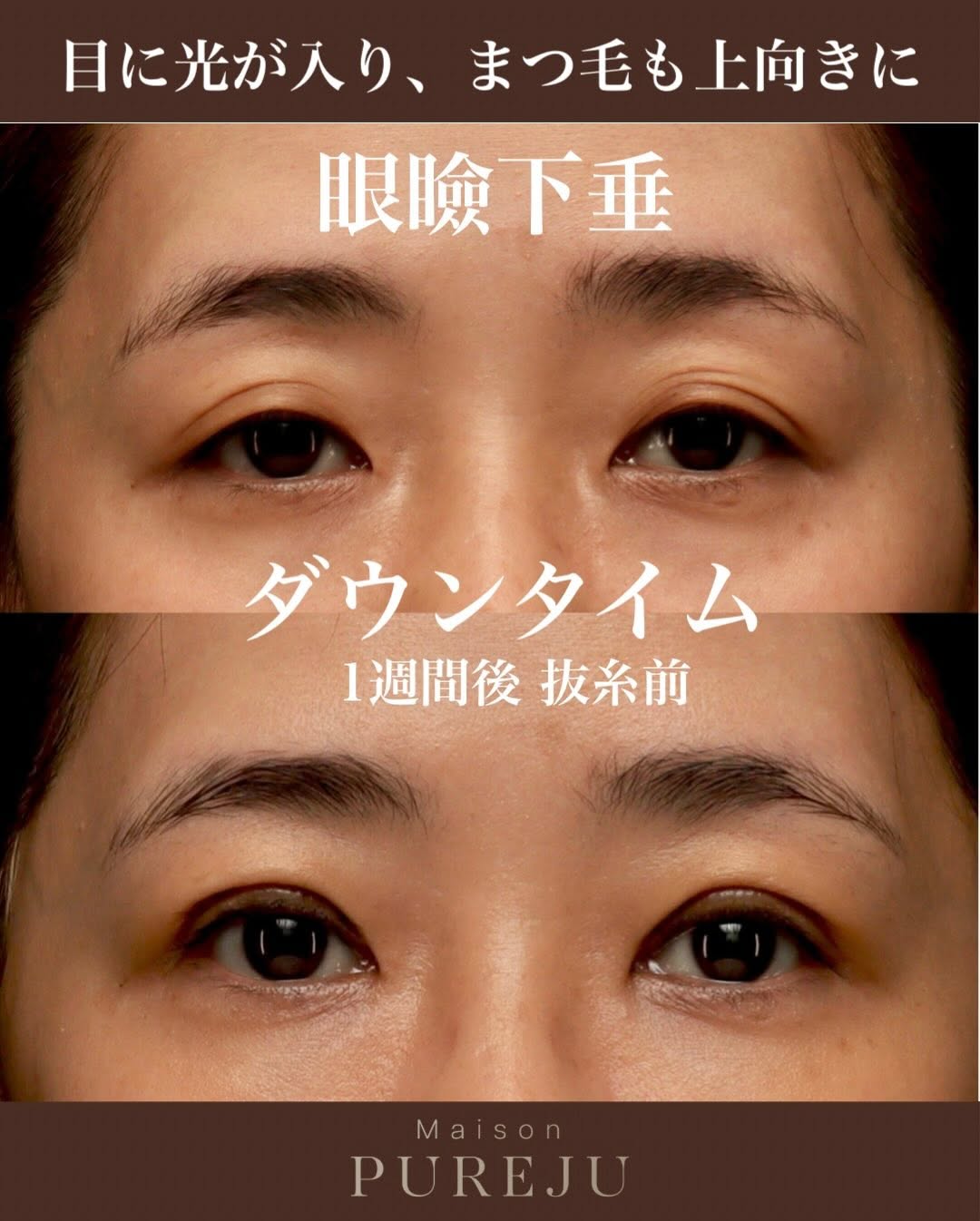 眼瞼下垂手術術後1週間（抜糸前）のダウンタイム経過を記録した症例