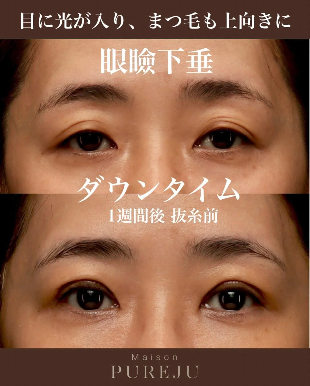 眼瞼下垂手術術後1週間(抜糸前)のダウンタイム経過を記録した症例