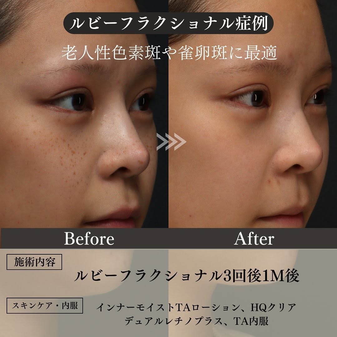 シミの種類4つを徹底解説｜ADM・そばかす・老人性色素斑・肝斑の特徴とおすすめ治療 画像4