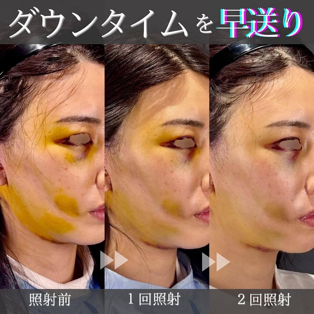 KOライト2日連続照射で他院フェイスリフト後の内出血と腫れを大幅に改善した症例 画像3