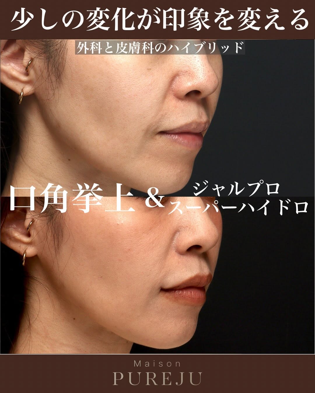 口角挙上＋ジャルプロスーパーハイドロで口元の若返りを実現した症例 画像2