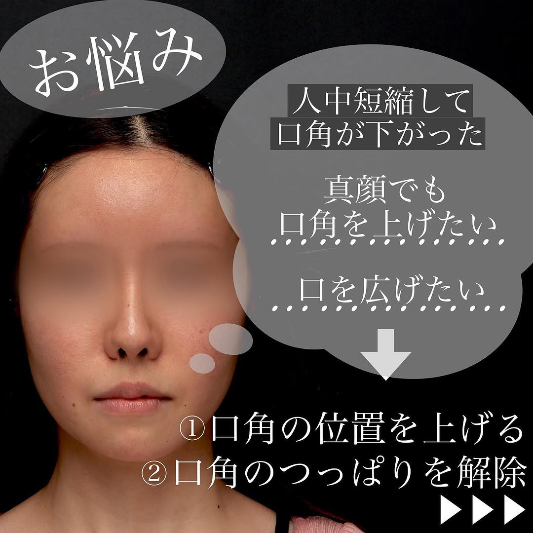 口角挙上で笑いやすさと口角の上がりを同時に改善した症例 画像3