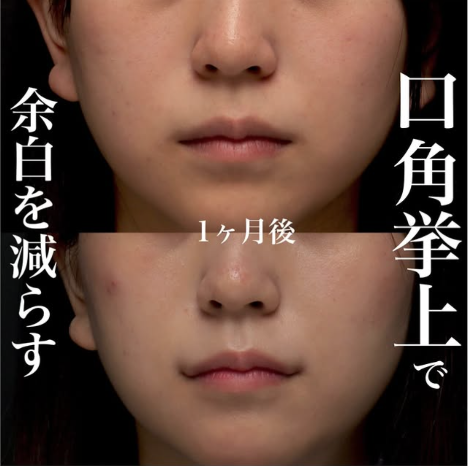 口角挙上で顔の余白を減らし中顔面を短く見せた症例（術後1ヶ月）