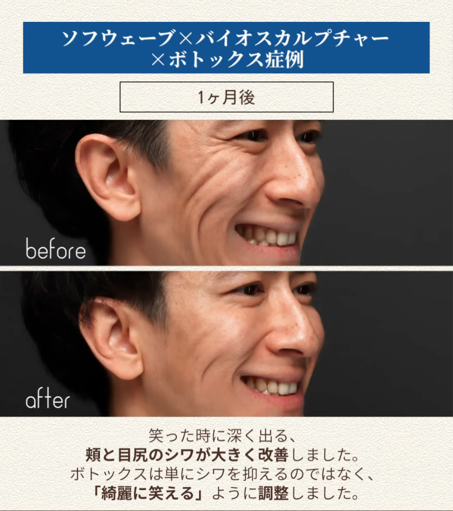 ソフウェーブ×バイオスカルプチャー×ボトックスの複合治療で笑った時の深い表情ジワを改善した症例（1ヶ月後）  画像3